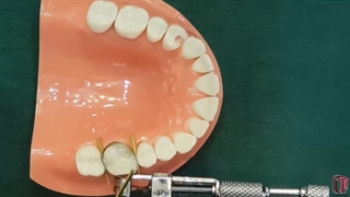 build up دندان های مولر بالا و پایین