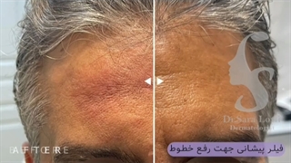 فیلم تزریق فیلر پیشانی دندان پیش