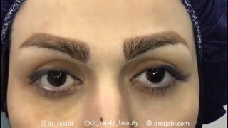 جراحی شکستگی کاسه چشم