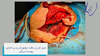 تومور بدخیم پاروتید با درگیری پوست