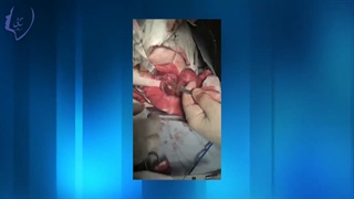 فیلم جراحی تیروئید