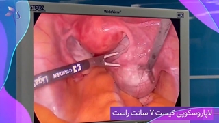 لاپارسکوپی کیست 7 سانتی