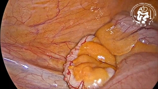 آپاندکتومی لاپاروسکوپیک با استاپلر