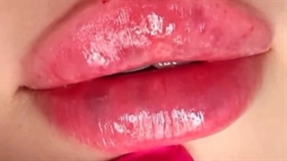 تزریق ژل لب روسی