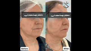 لیفتینگ و جوانسازی پوست با دستگاه پزشکی Endo-RF Subcision