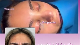 لیفت آندوسکوپی ابرو