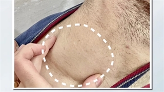 درمان سرطان غدد لنفاوی