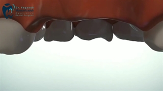 ایمپلنت دندان