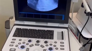 بارداری پس از ١٤ سال با یک لوله رحمی و پس از یکبار IVF و یکبار میکرو اینجکشن ناموفق و یکبار حاملگی خارج رحمی