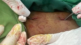 جراحی بی اختیاری ادراری و افتادگی مثانه