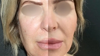 لاغری غبغب با اوندا