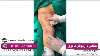 فیلم واقعی جراحی لیفت بازو (براکیوپلاستی)