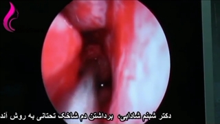 جراحی همزمان زیبایی بینی و رفع مشکل تنفسی به روش آندوسکوپی