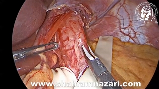 روش جراحی میوتومی هلر لاپاروسکوپیک در درمان آشالازی توسط دکتر نظری