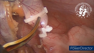 برداشتن آپاندیس با لاپاروسکوپی