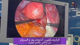 دردهای شدید در خانم جوان و لاپاراسکوپی کیست اندومتریوز