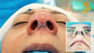 جراحی بینی در خانمی جوان| دکتر سعید ظفرمند