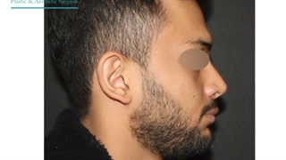 عمل بینی مردانه