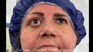 تومور بزرگ غده اشکی