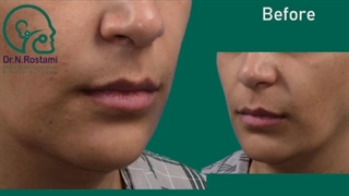 تزریق فیلر لب به صورت کاملا طبیعی