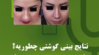 نتیجه جراحی بینی گوشتی