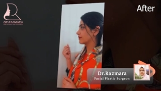 سه ماه بعد از جراحی بینی
