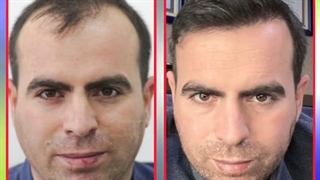 بدون عوارض در کلینیک ترانسپلنت مو بکارید!