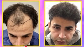 کاشت مو بدون عوارض با تکنیک های جدید