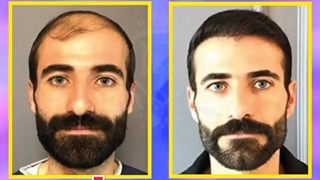 بدون عوارض جانبی در کلینیک معتبر مو بکارید!