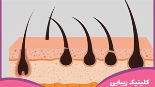 لیزر موهای زائد