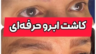 مراجعه کننده در کلینیک کاشت ابروی ترانسپلنت