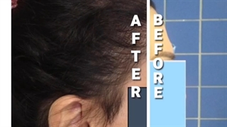 کاشت موی سر در خانم ها