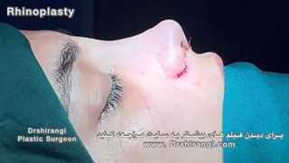 فیلم نحوه عمل رینوپلاستی بینی