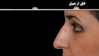 ده سال بعد از عمل زیبایی بینی | دکتر امید ابراهیمی
