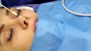 جراحی لیفت کناره چشم به همراه ترمیم بینی