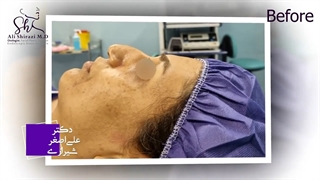 قبل و بعد از جراحی بینی کج با افتادگی سر بینی