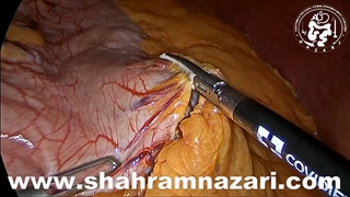 چاقی مرضی / اسلیو معده