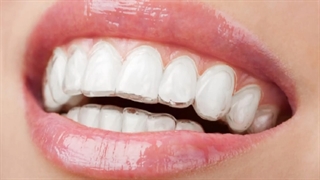 مزایا و معایب ارتودنسی نامرئی | دکتر داودیان