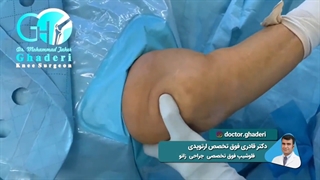 تعویض مفصل خانم 56 ساله