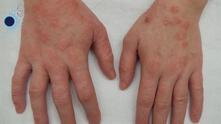 آلرژی های تماسی پوست