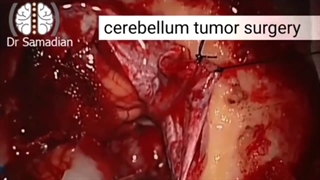 عمل جراحی تومور مخچه