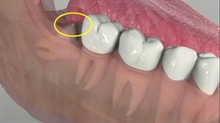 دکتر وحید دهقان : دندان عقلم را خارج کنم؟