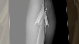 شکستگی اطراف استم و درمان با پلاک