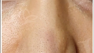 کوچک کردن بینی با اندولیفت