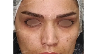 درمان لک صورت با لیزر