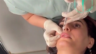 اصلاح فرم لب ها با متد روسی فیلم تزریق ژل لب | دکتر فرشته جلالپور