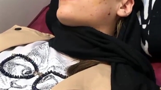 برداشتن خال صورت دختر جوان