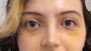 نتیج عمل بینی بلافاصله بعد از برداشتن گچ بینی | دکتر  محمدعلی حسینی