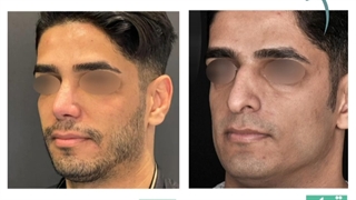 جراحی رینوپلاستی