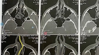 عمل سپتوراینوپلاستی در بیمار با سپتوم دارای انحراف شدید